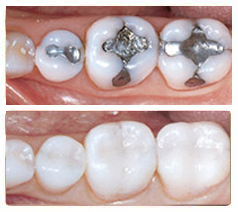 Composite Fillings - Mountain Dental Oak Ridge TN