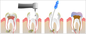 Root Canal Therapy - Mountain Dental Oak Ridge TN