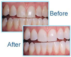 Teeth Whitening - Mountain Dental Oak Ridge TN